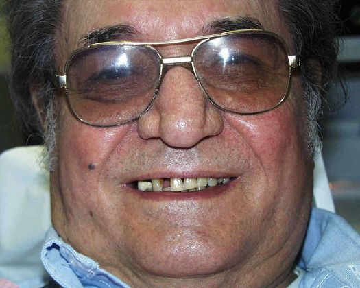 Replacing Missing Teeth Case 4 - Before