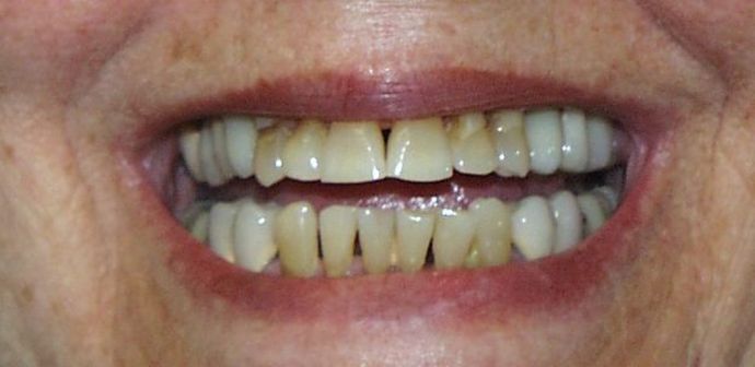 Cosmetic Dentistry: Case 10 - Before: Close Up