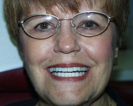 Cosmetic Dentistry: Case 10 - After