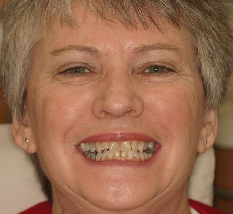 Cosmetic Dentistry: Case 11 - Before