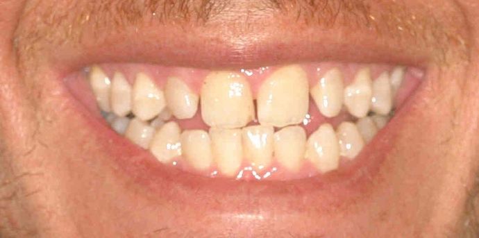 Cosmetic Dentistry: Case 12 - Before: Close Up