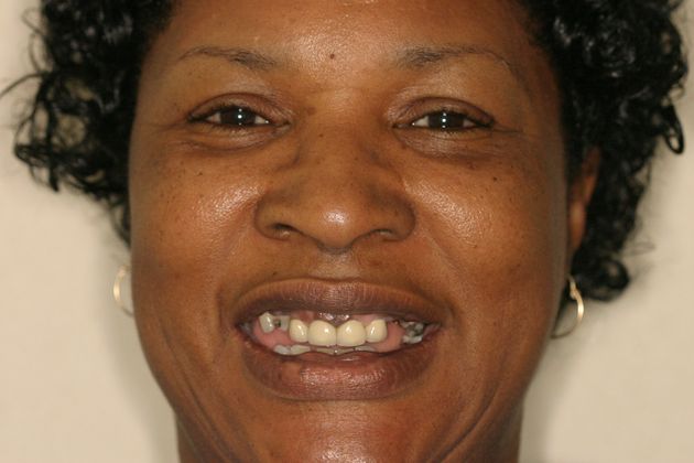 Replacing Missing Teeth: Case 5 - Before
