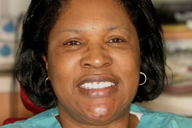 Replacing Missing Teeth: Case 5 - After