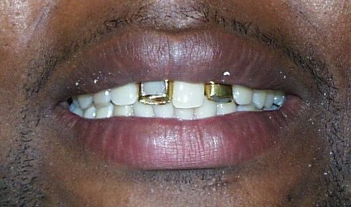 Cosmetic Dentistry: Case 15 - Before: Close Up