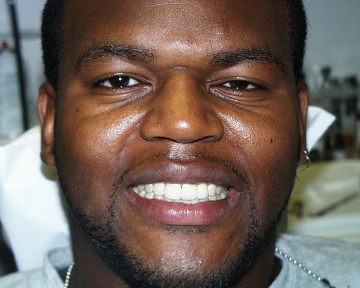 Cosmetic Dentistry: Case 15 - After