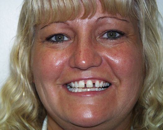 Replacing Missing Teeth Case 6 - Before