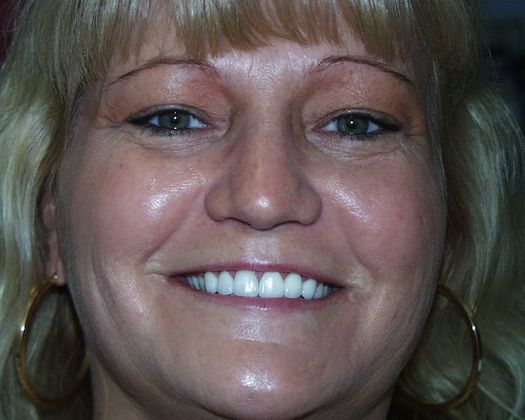 Replacing Missing Teeth Case 6 - After