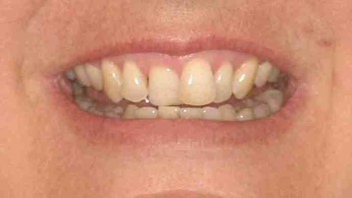 Cosmetic Dentistry: Case 16 - Before: Close Up