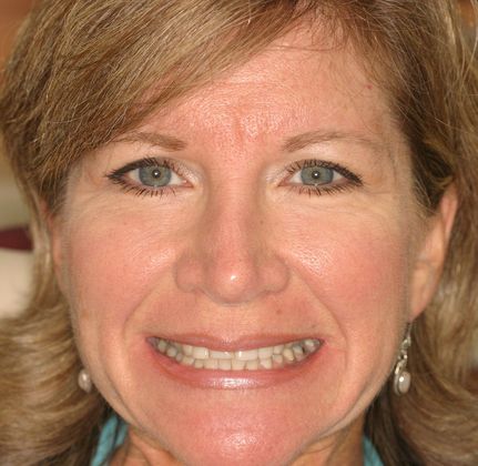 Cosmetic Dentistry: Case 17 - Before