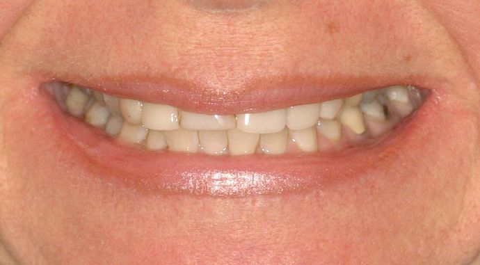 Cosmetic Dentistry: Case 17 - Before: Close Up