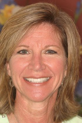 Cosmetic Dentistry: Case 17 - After