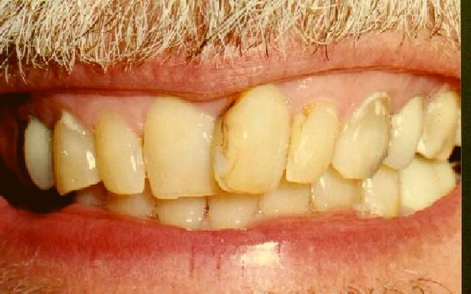 Cosmetic Dentistry: Case 18 - Before