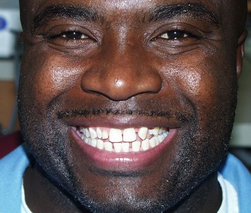 Replacing Missing Teeth Case 7 - Before