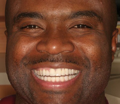 Replacing Missing Teeth Case 7 - After