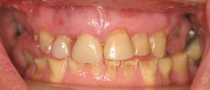 Cosmetic Dentistry: Case 21 - Before: Close Up