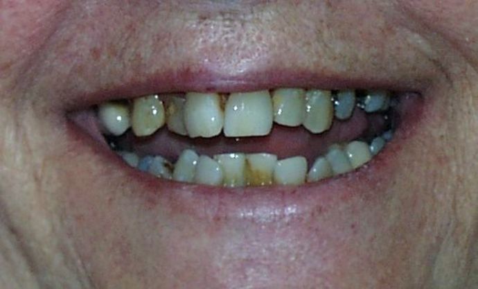Cosmetic Dentistry: Case 23 - Before: Close Up