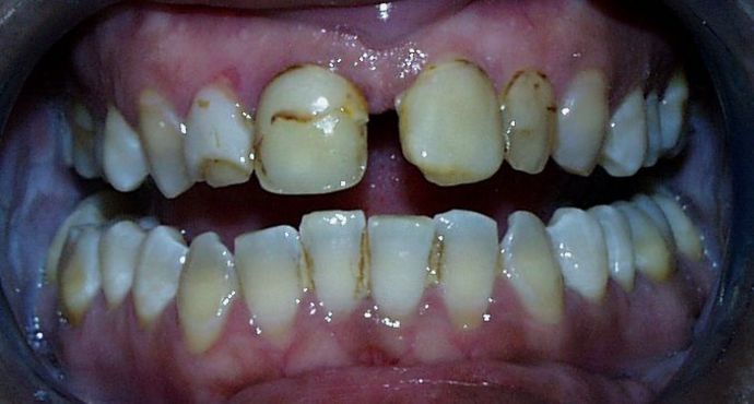 Cosmetic Dentistry: Case 24 - Before: Close Up