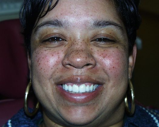 Cosmetic Dentistry: Case 24 - After