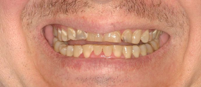Cosmetic Dentistry: Case 26 - Before: Close Up