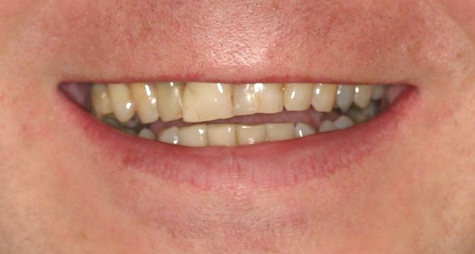 Cosmetic Dentistry: Case 28 - Before: Close Up