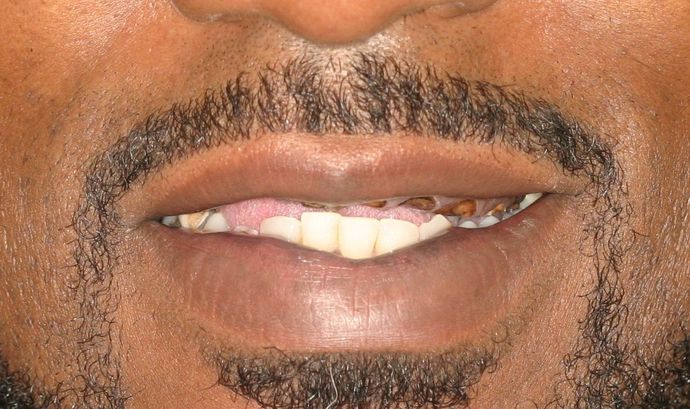 Replacing Missing Teeth Case 8 - After