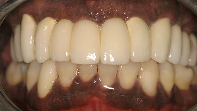 Replacing Missing Teeth: Case 8 - After: Close Up