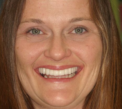 Dental Implants: Case 3 - After