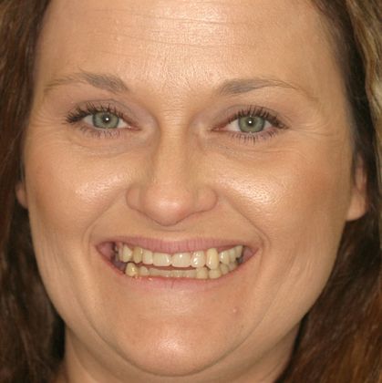 Replacing Missing Teeth Case 9 - Before