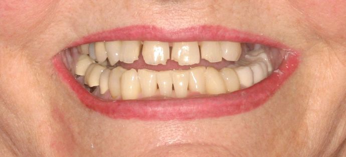 Replacing Missing Teeth Case 10 - Before