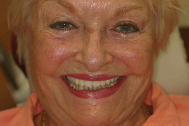 Replacing Missing Teeth Case 10 - After