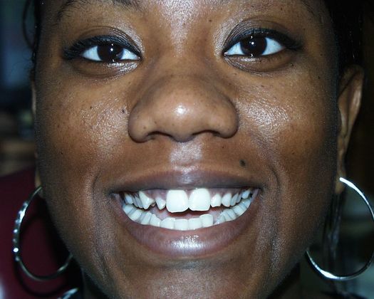 Cosmetic Dentistry: Case 30 - Before