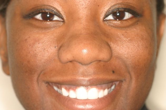 Cosmetic Dentistry: Case 30 - After