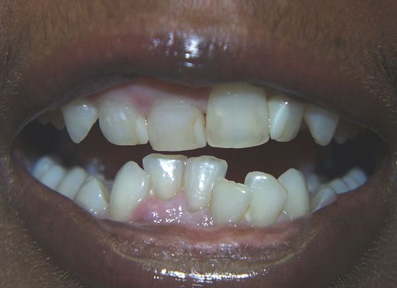 Replacing Missing Teeth Case 11 - Before