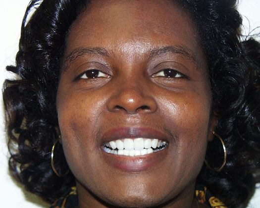 Replacing Missing Teeth Case 11 - After