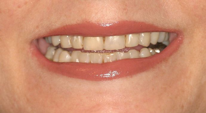 Cosmetic Dentistry: Case 32 - Before: Close Up