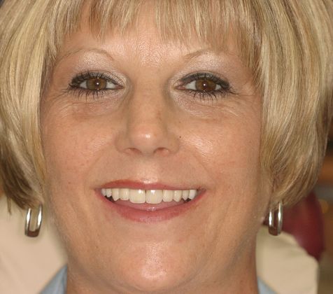 Cosmetic Dentistry: Case 32 - After