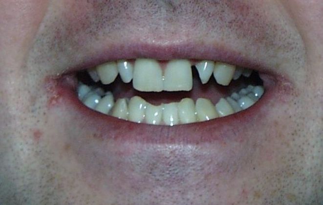 Cosmetic Dentistry: Case 34 - Before: Close Up