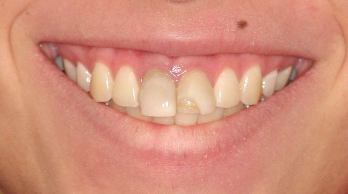 Cosmetic Dentistry: Case 35 - Before: Close Up