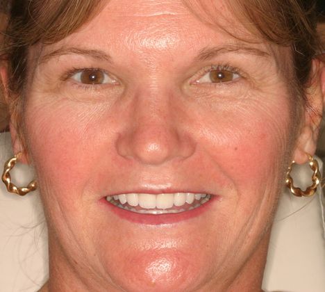 Cosmetic Dentistry: Case 36 - After