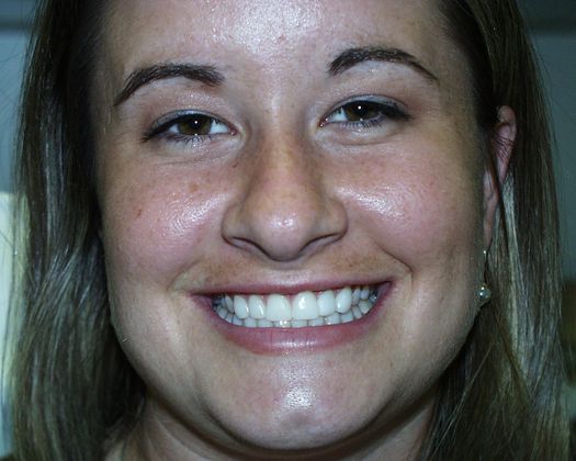 Bonding: Case 1 - Jennifer had gone through braces which couldn