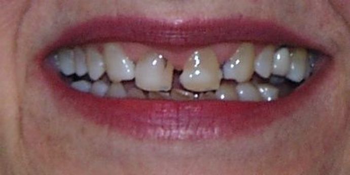 Replacing Missing Teeth Case 12 - Before