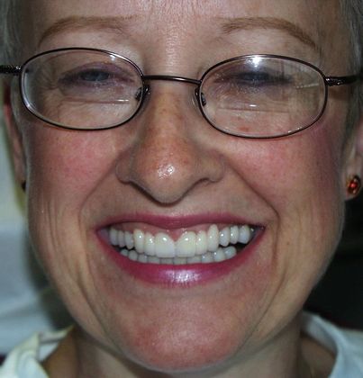 Replacing Missing Teeth Case 12 - After