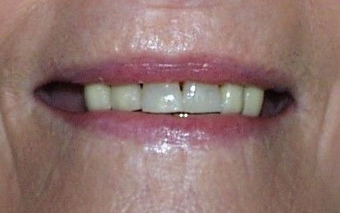 Replacing Missing Teeth Case 13 - Before