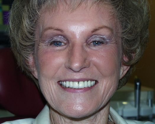 Replacing Missing Teeth Case 13 - After