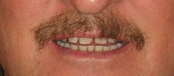 Cosmetic Dentistry: Case 39 - Before: Close Up