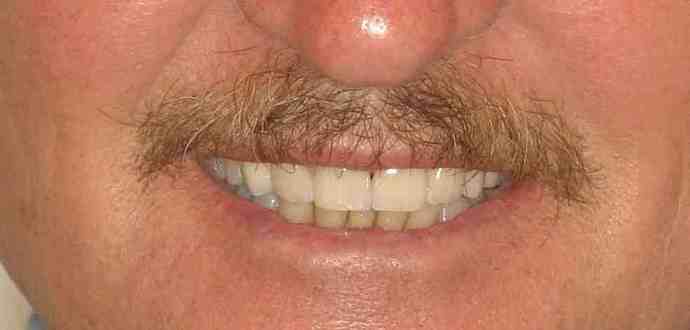 Cosmetic Dentistry: Case 39 - After: Close Up