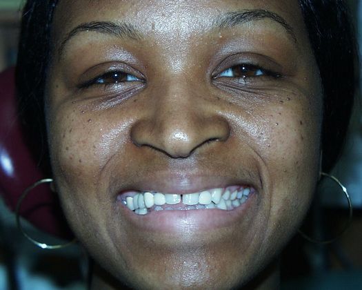 Cosmetic Dentistry: Case 40 - Before