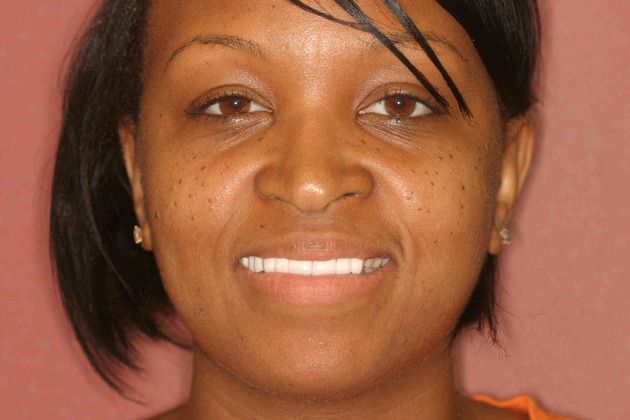 Cosmetic Dentistry: Case 40 - After