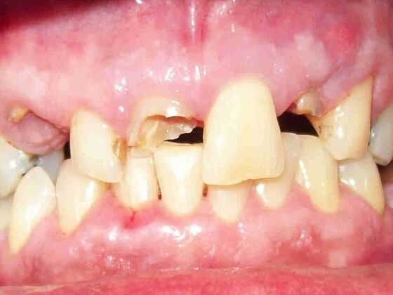 Smile Makeovers, actual cases of our dentists, no special lighting or editing: Case 1 - Before Fixed Bridge