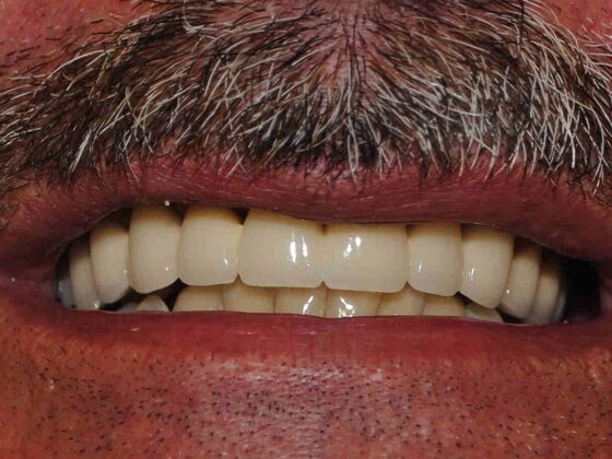 Smile Makeovers, actual cases of our dentists, no special lighting or editing: Case 1 - After Fixed Bridge